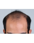 Before Hair Transplant&nbsp;Front